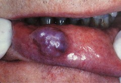 Haemangioma