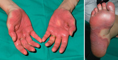 Hand Foot Syndrome