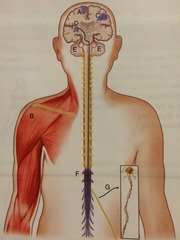 Hemiplegia