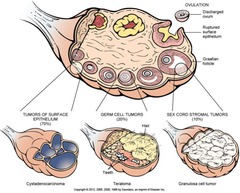 Histogenesis of Ovarian Tumors
