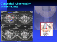 horseshoe kidney on CT  horseshoe kidney is prone to what 4 things?