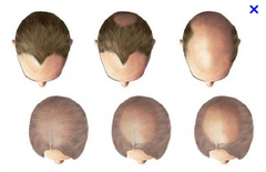 How can you treat androgenetic alopecia? How can you test for it?