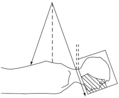 How do you calculate the Collimator angle of cranial field to match the inferior border with the superior border of spine field?