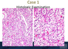 How does clear cell carcinoma appear histologically?