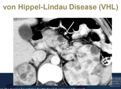 How does clear cell RCC usually present? Is it solitary? Unilateral? Sporadic?