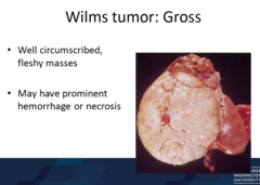 How does Wilms tumor appear grossly?