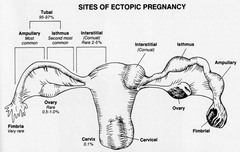 How is Ectopic Pregnancy defined? What are the risk factors for having an Ectopic Pregnancy? What are the presenting symptoms?