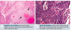 How is squamous cell carcinoma defined on histology?