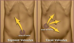 How is the diagnosis of a cecal volvulus made?