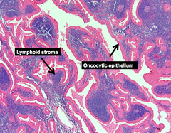 Hürthle cells/oncocytes
