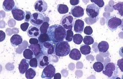 Hyperleukocytosis and Leukostasis