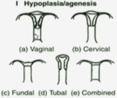 Hypoplasia/Agenesis of Uterus: description, cause, association