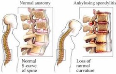 If Ankylosing Spondylitis gets so severe, what happens?