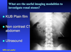 imaging modalities to investigate renal stones  when can US be used?