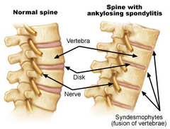 In Ankylosing spondylitis, where in the spine does the stiffness and pain begin? and then where does it move?