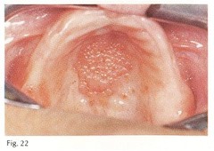 Inflammatory Papillary Hyperplasia