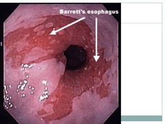 Intestinal metaplasia (Barrett's esophagus)