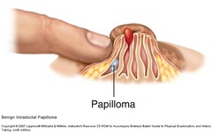 Intraductal Papilloma