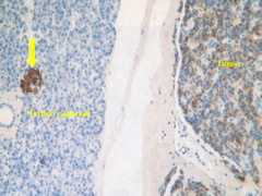 Islet cell tumor showing immunoperoxidase stain for insulin