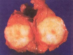 Islet cell tumor