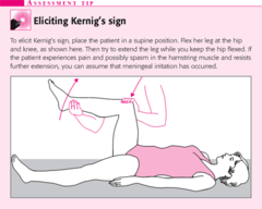 Kernig's sign
