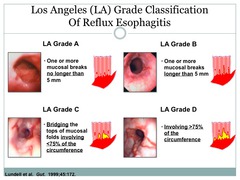 LA grade A esophageal reflux