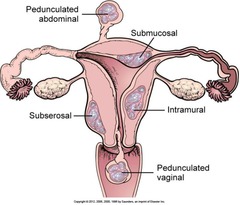 Leiomyoma of the Uterus