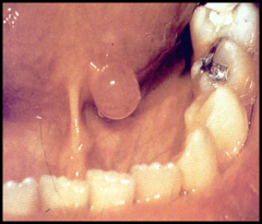 lesion contains fluid, has translucent appearance and a soft consistency