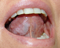 LEUKOPLAKIA