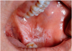 Lichenoid reactions