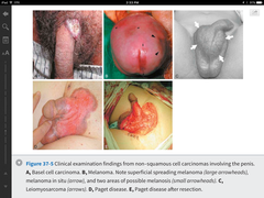 List 6 types of non-squamous penile cancers.