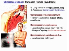 Local Complications of Lung Carcinoma What happens if the tumor compresses the sympathetic chain?