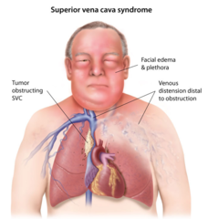 Local Complications of Lung Carcinoma What is SVC Syndrome?