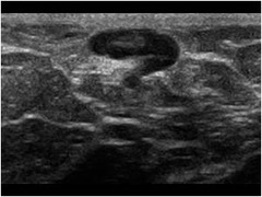 lymph node on ultrasound