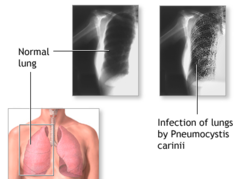 Major lung infection with fever, cough, chest pain, and sputum; treated with Bactrim: a. Kaposi sarcoma b. Herpes simplex c. Cryptococcus d. Toxoplasmosis e. Pneumocystis carinii pneumonia