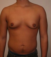 MALE BREAST ABNORMALITIES  GYNECOMASTIA