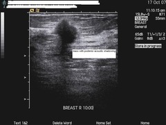 malignant features of breast masses on ultrasound