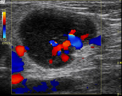 malignant ultrasound features in lymph nodes