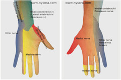 Median nerve injury/laceration