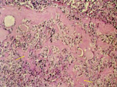 Medullary carcinoma- histo