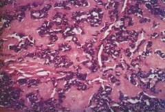 Medullary carcinoma histology