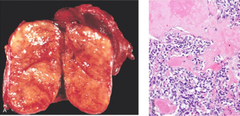 medullary carcinoma