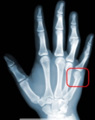 Metacarpal Fractures:   -Classified according to location (head, neck, shaft, base) -Common complication is rotational deformities   i.e. ___1___: a fracture to the 5th Metacarpal, which requires a ___2___ splint