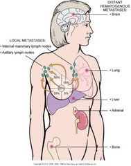 Metastases: Breast Carcinoma