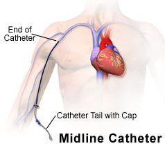 midline catheters