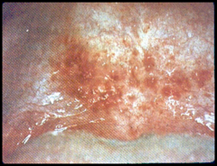 minute red spot on skin/mucous membrane resulting from escape of small amount of blood
