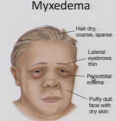 Myxedema