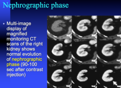 nephrogenic phase is used to eval what?