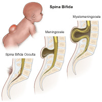 Neural Tubal Defects - Myelomeningocele or Spina Bifida