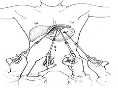 Nissen Fundoplication